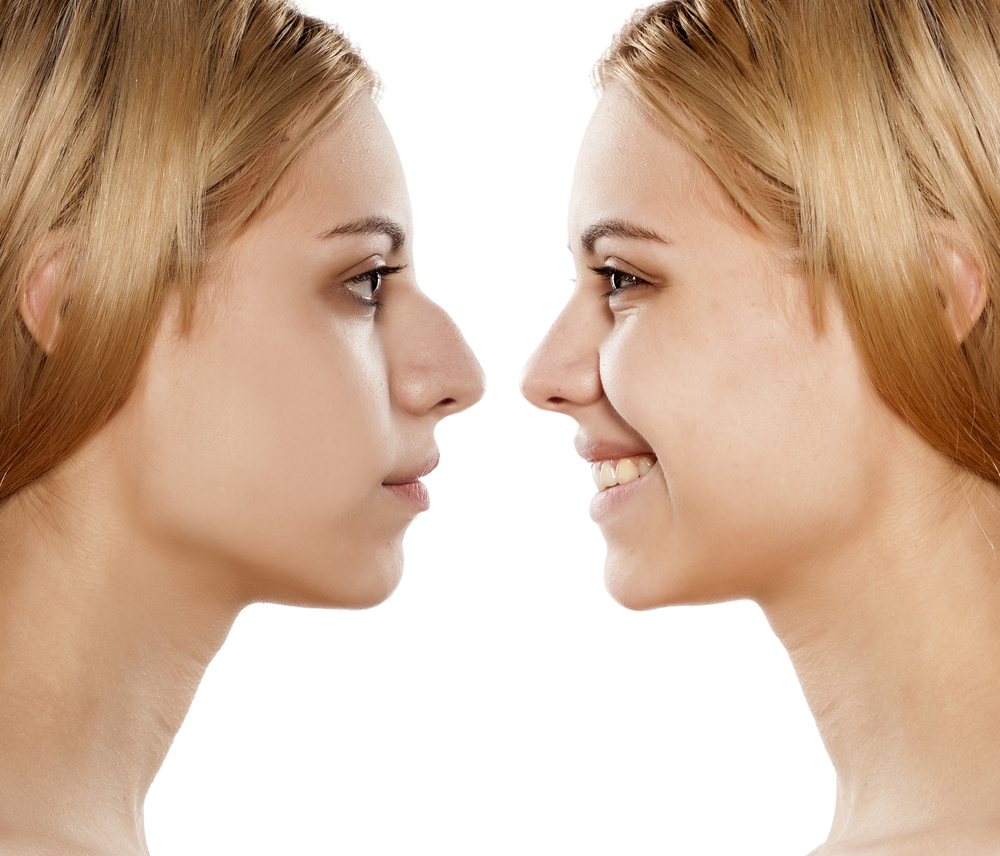 Everything You Need to Know About Getting a Nose Job.