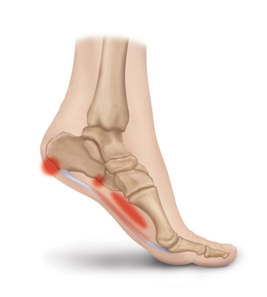 Plantar Fasciitis