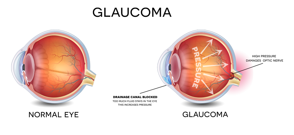 glaucoma image