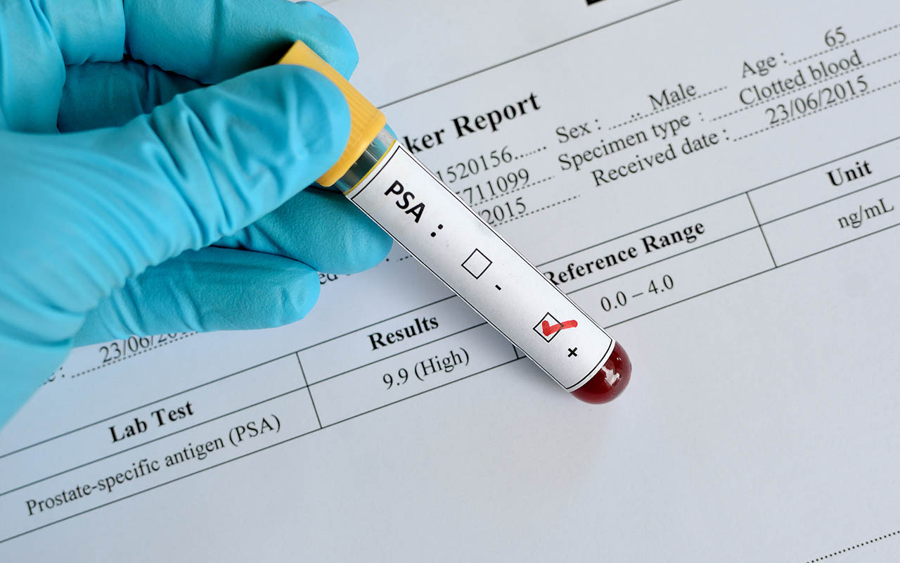 Prostate Cancer Screening