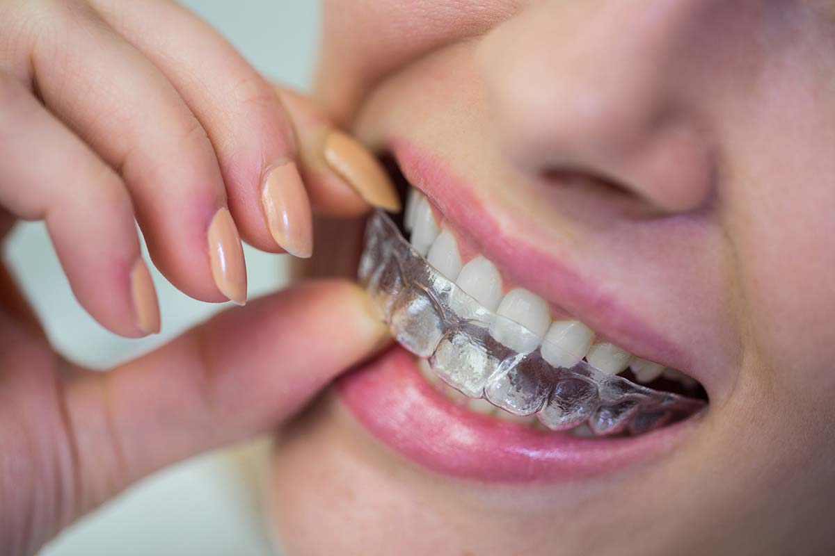 about Invisalign