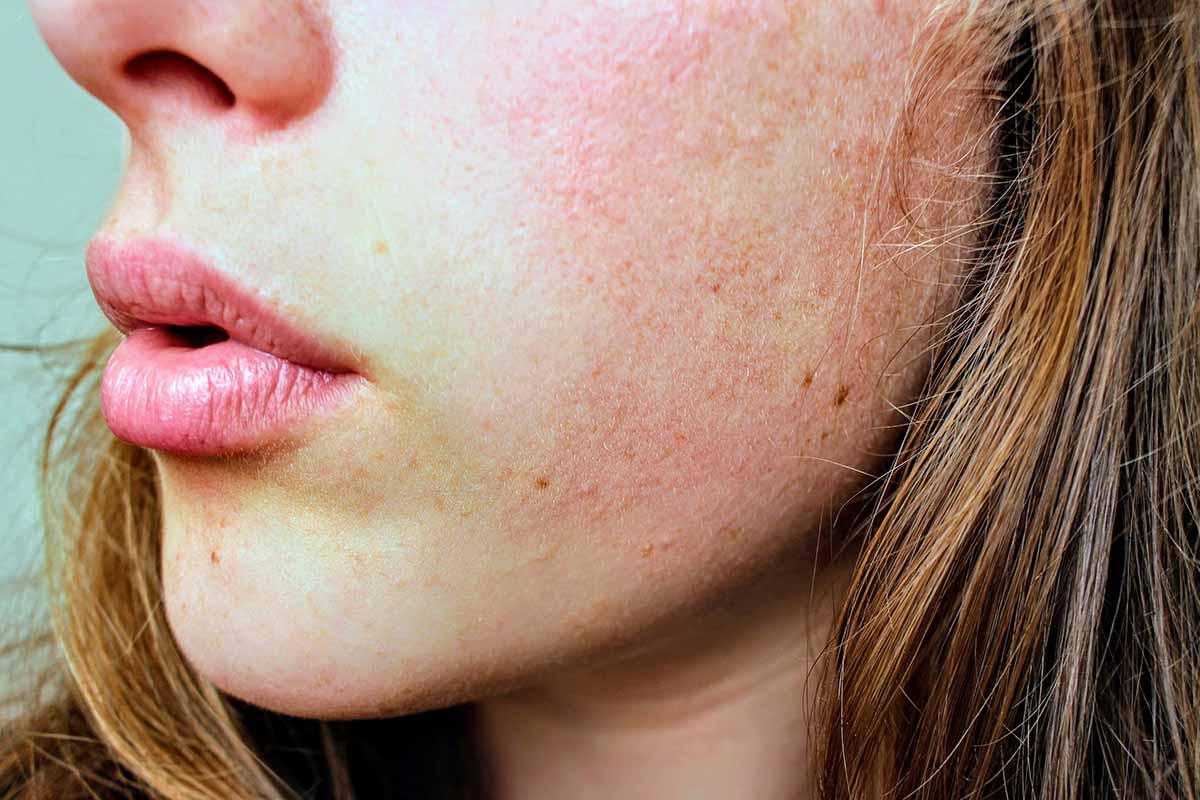 How Do Allergies Affect Our Skin