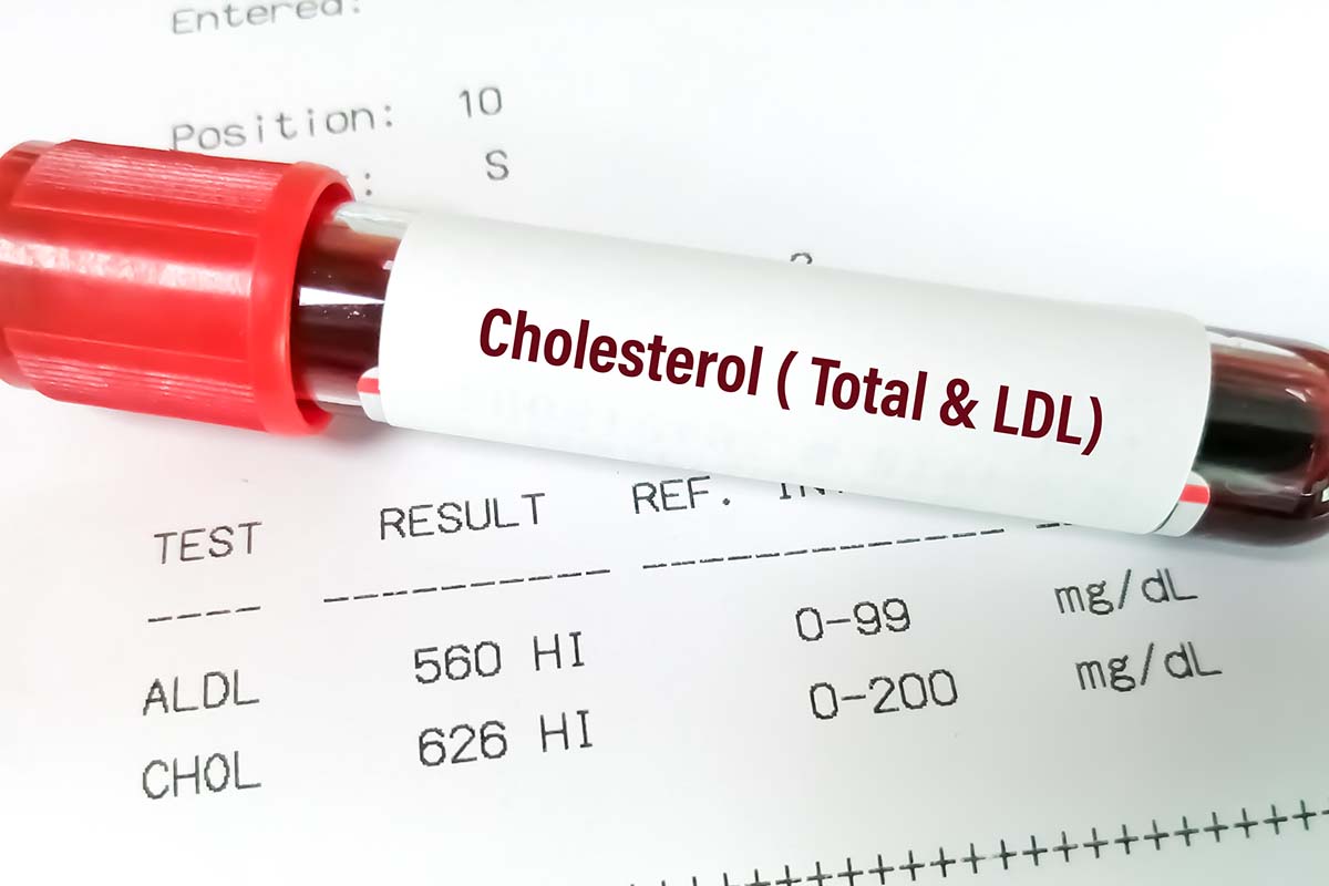 What Cholesterol Lab Tests Reveal